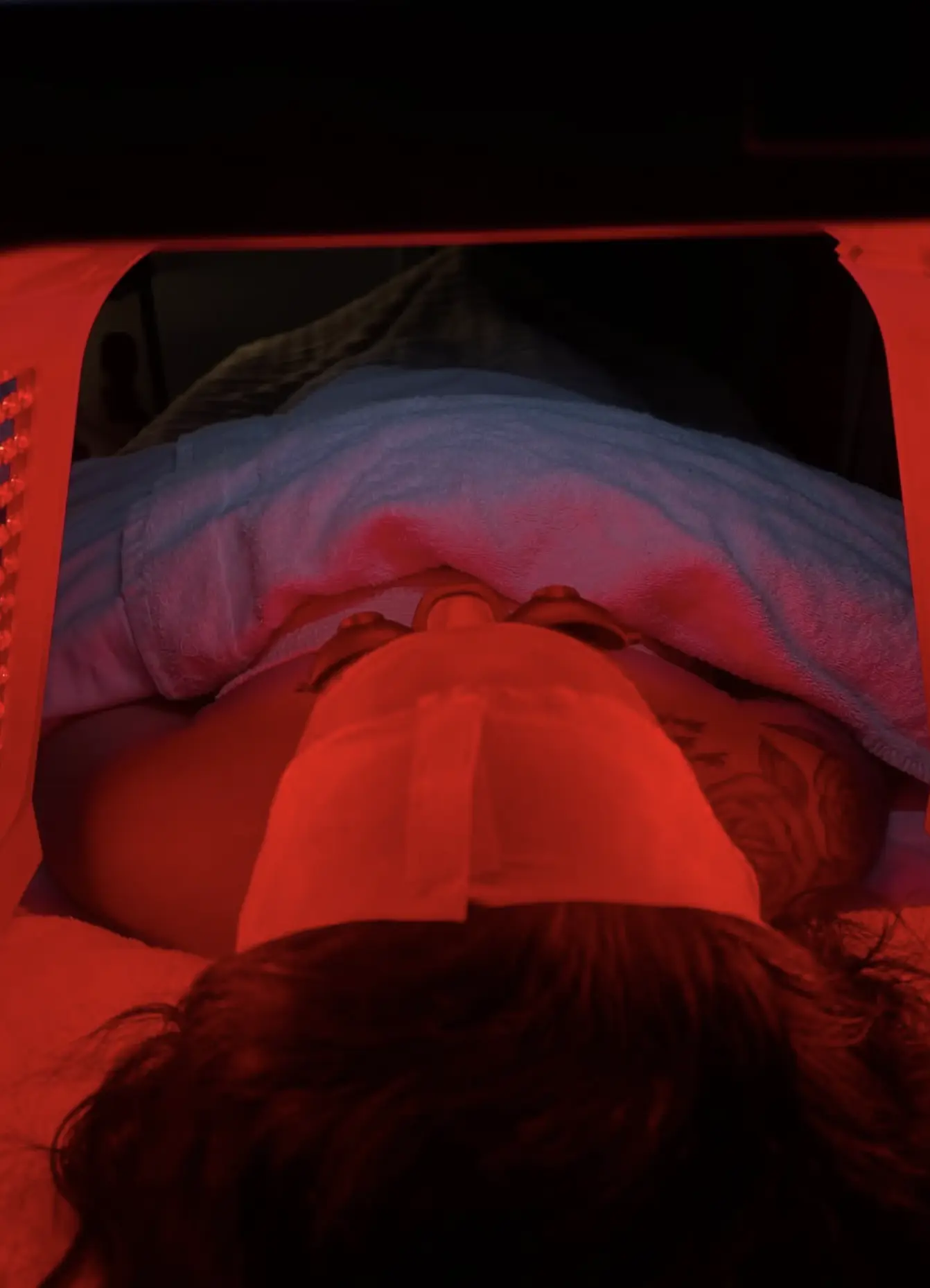 IPL photofacial