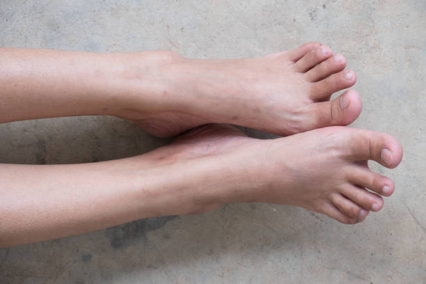 A Teaspoon of Turmeric | Effective Treatment and Prevention Tips for Deep Foot Calluses